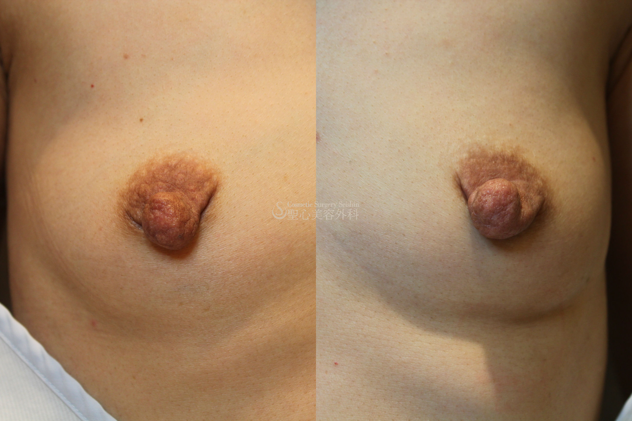 【40代女性】乳頭縮小（1ヶ月） Before 