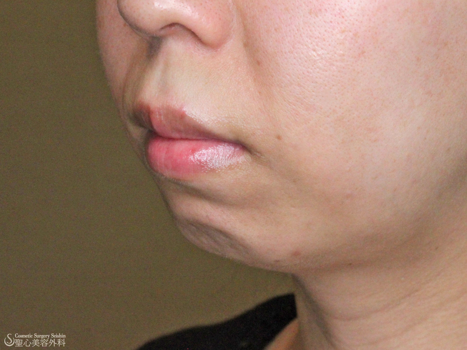 【30代女性・アゴを整える】プロテーゼ（術後経過） Before 