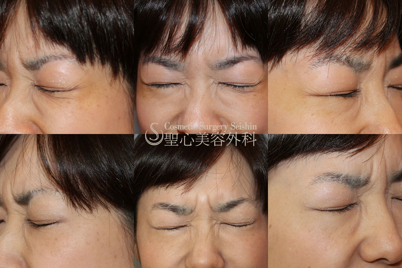 【30代女性・目尻のしわ】目尻ボトックス After 