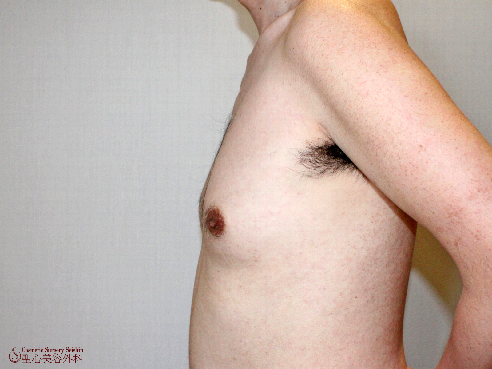 【40代男性・女性化乳房】ベイザー脂肪吸引（術後1ヶ月） Before 
