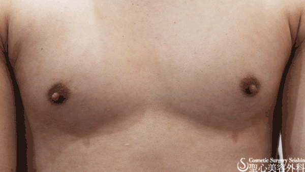【男性】乳頭縮小 Before 