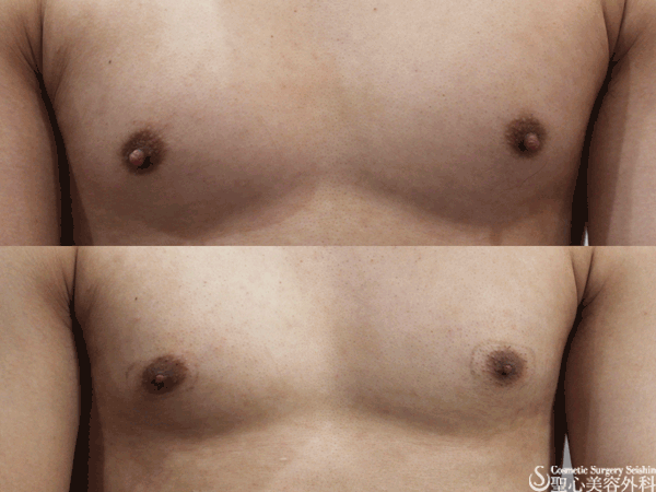 【男性】乳頭縮小 After 