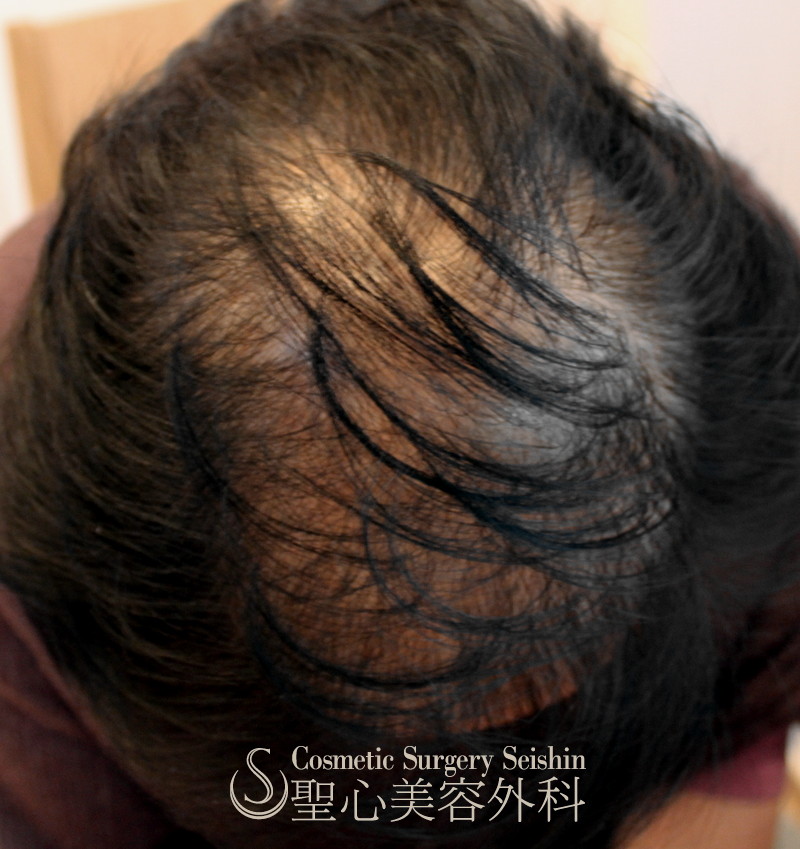 【50代女性・薄毛】グロースファクター再生療法（16回コース）・KIPスカルプヘアーエッセンス・パントガール（6ヶ月後） Before 