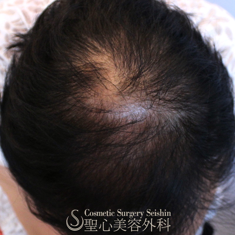 【50代女性・薄毛】グロースファクター再生療法（16回コース）・KIPスカルプヘアーエッセンス・パントガール（6ヶ月後） After 