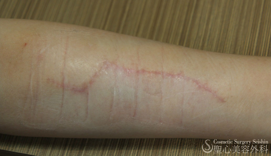 代 女性 リストカット跡修正 分割切除 症例写真 美容整形 美容外科なら聖心美容クリニック 代 女性 リストカット跡修正 分割切除 症例写真 美容整形 美容外科なら聖心美容クリニック