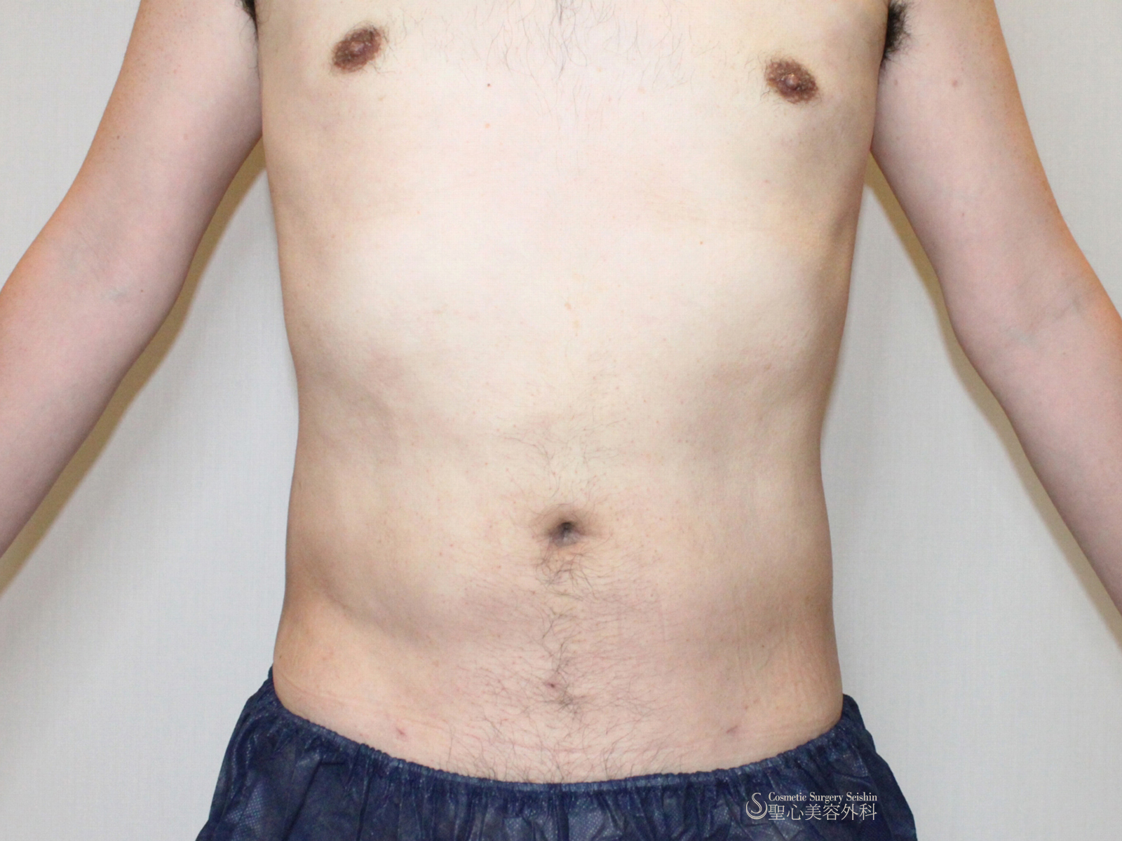 40 代 男性 胸 の 脂肪