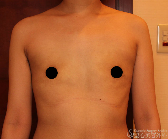 【20代・性同一性障害（FTM）】乳腺切除、脂肪吸引（1ヶ月後） After 