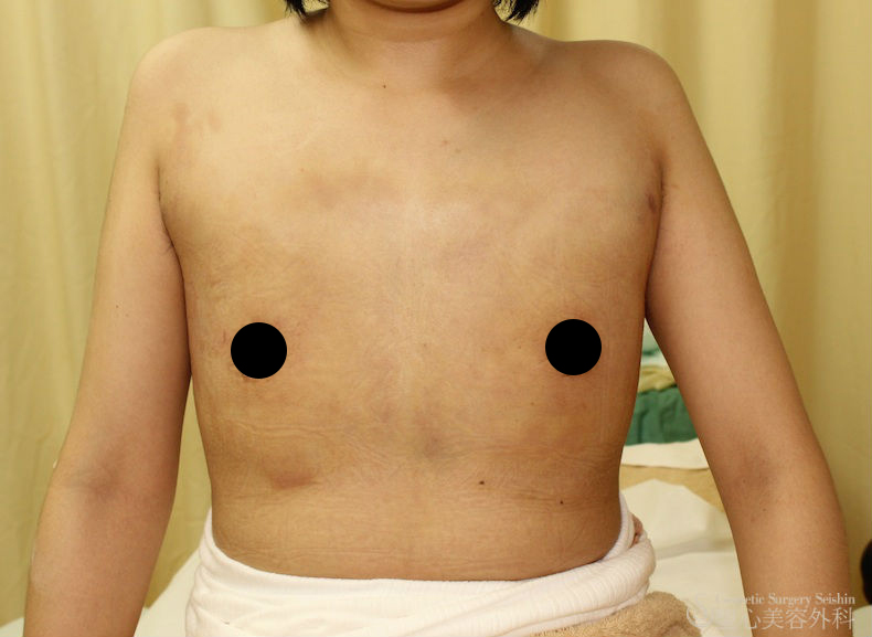 【20代・性同一性障害（FTM）】乳腺切除、脂肪吸引（1ヶ月後） After 