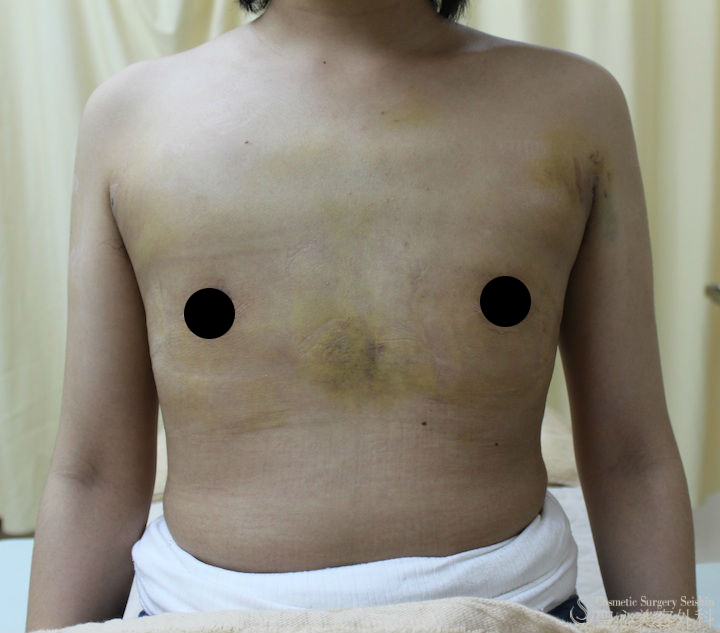【20代・性同一性障害（FTM）】乳腺切除、脂肪吸引（1ヶ月後） After 