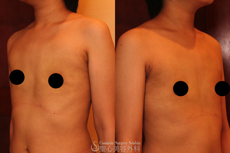 【20代・性同一性障害（FTM）】乳腺切除、脂肪吸引（1ヶ月後） After 