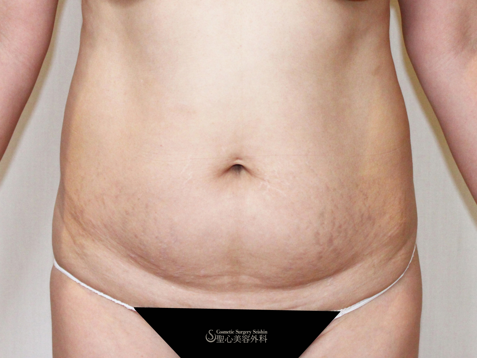 【40代女性・お腹】ボディジェット脂肪吸引（術後1年） Before 
