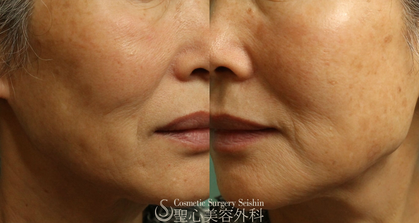 60代女性 シミ ライムライト しみlz N トレチノインライン 症例写真 美容整形 美容外科なら聖心美容クリニック