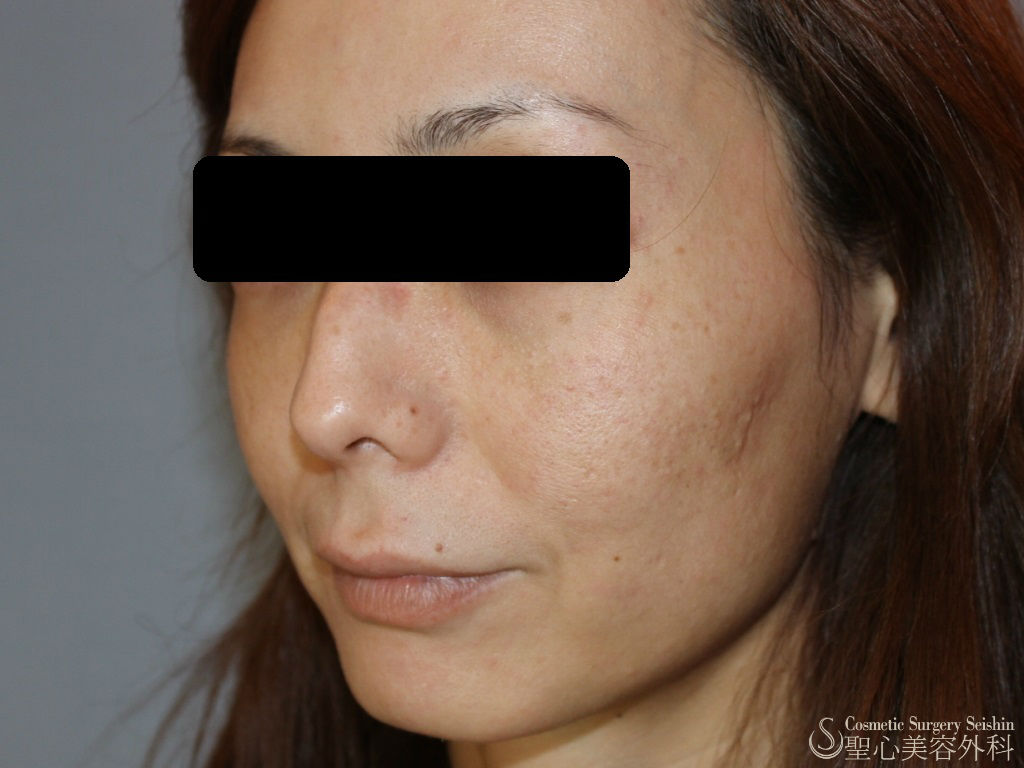 30代女性 毛穴の開き 頬のたるみ イントラセル 症例写真 美容整形 美容外科なら聖心美容クリニック 30代女性 毛穴の開き 頬のたるみ イントラセル 症例写真 美容整形 美容外科なら聖心美容クリニック