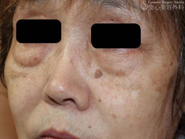 【70代女性・目の下のたるみの改善】経結膜下脱脂法+プレミアムPRP Before 