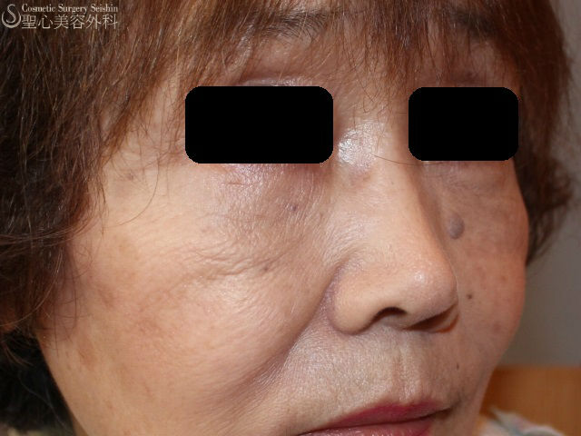 【70代女性・目の下のたるみの改善】経結膜下脱脂法+プレミアムPRP After 