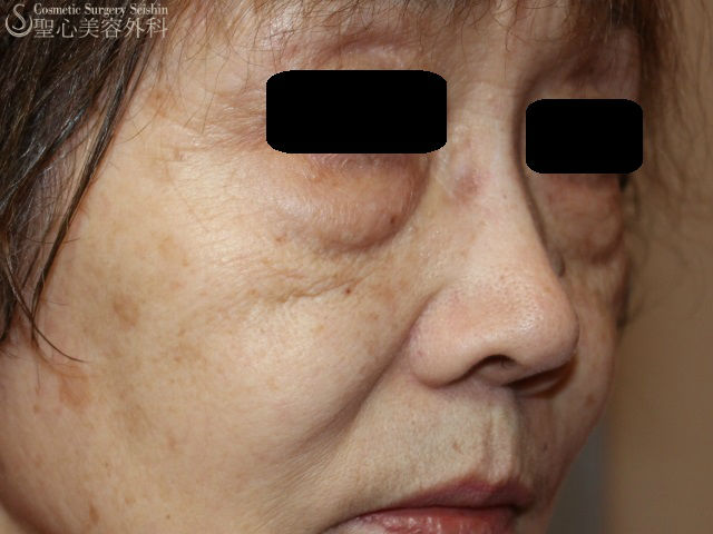【70代女性・目の下のたるみの改善】経結膜下脱脂法+プレミアムPRP Before 