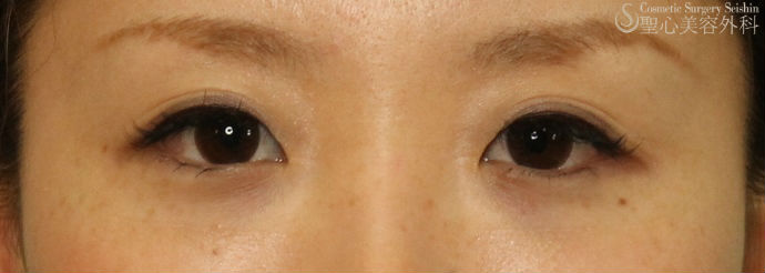 【20代女性・目元を可愛らしく】涙袋ヒアルロン酸注入 Before 