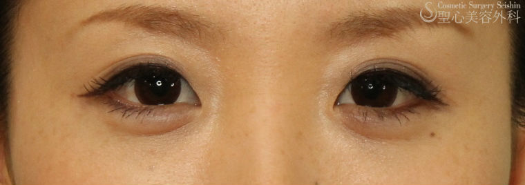 【20代女性・目元を可愛らしく】涙袋ヒアルロン酸注入 After 