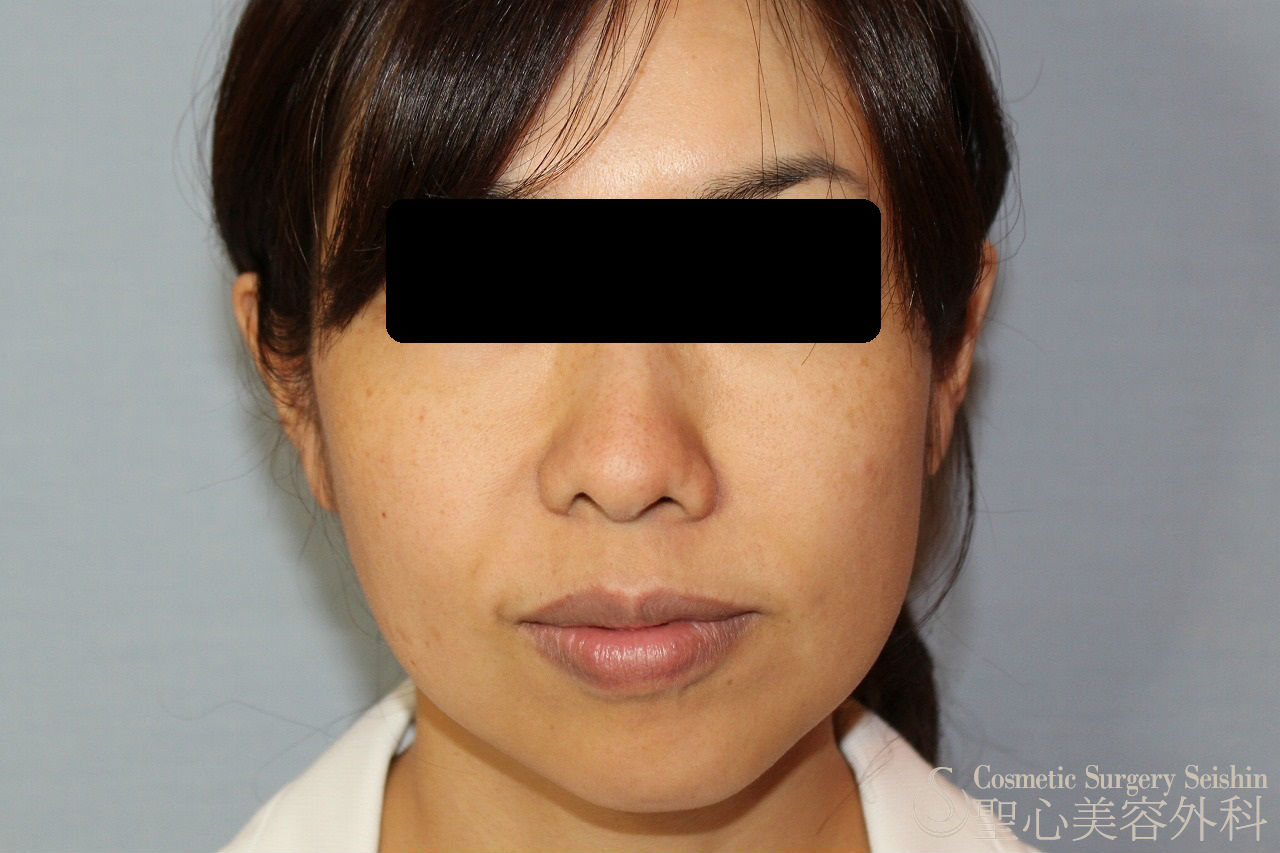 【30代女性・ほうれい線や頬のたるみ】プレミアムディメンショナルリフト（手術直後） Before 