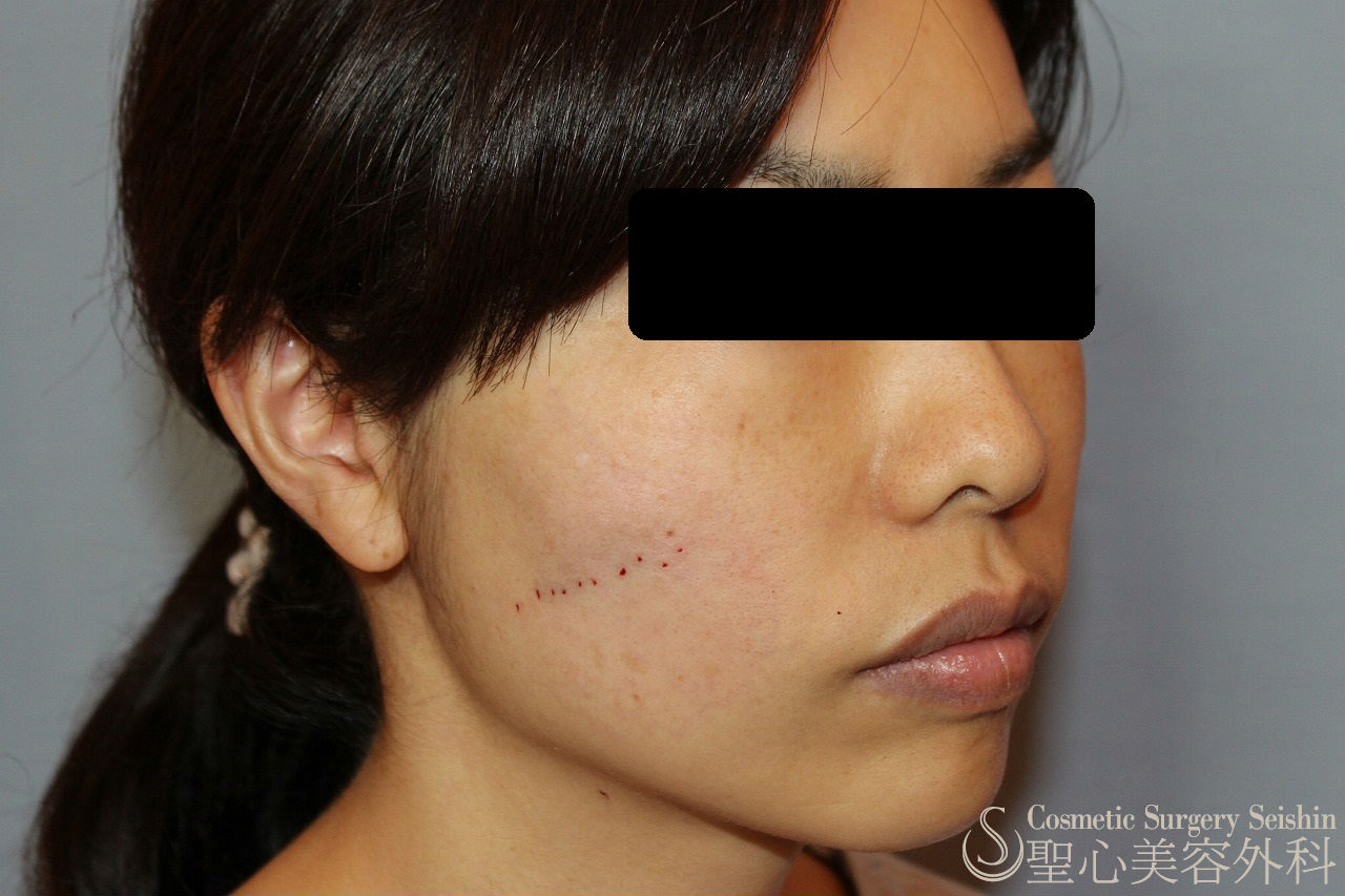 【30代女性・ほうれい線や頬のたるみ】プレミアムディメンショナルリフト（手術直後） After 