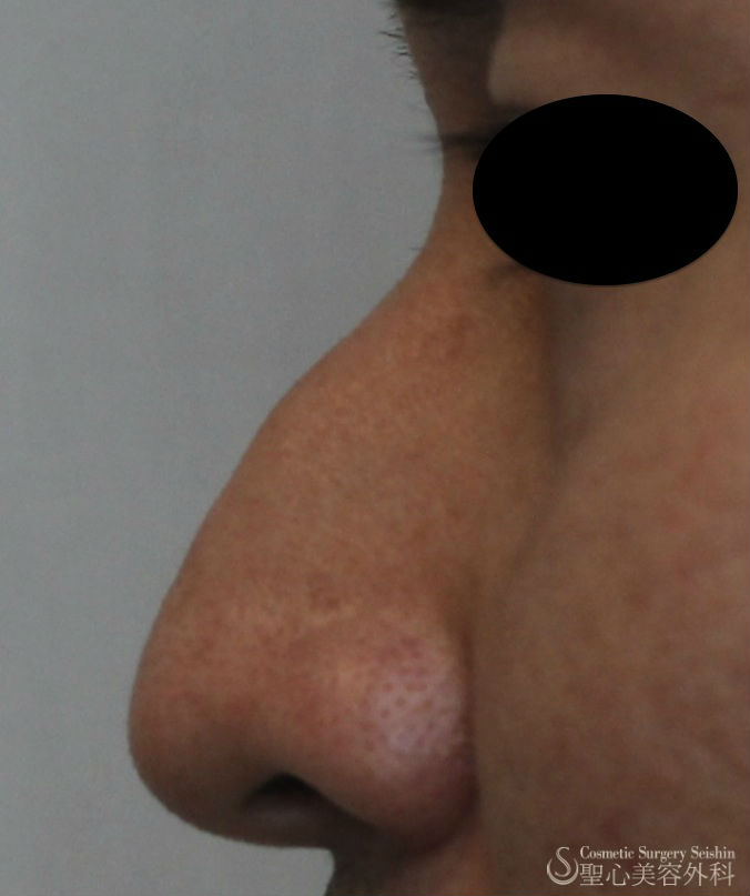 【20代男性・わし鼻の改善】鼻骨削り＋I型シリコンプロテーゼ（1ヶ月） Before 