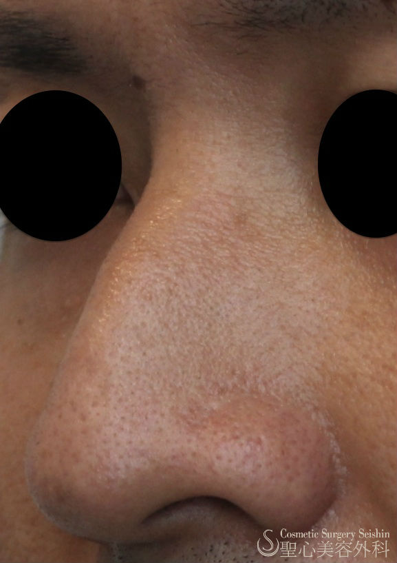 【20代男性・わし鼻の改善】鼻骨削り＋I型シリコンプロテーゼ（1ヶ月） Before 