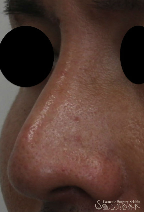 【20代男性・わし鼻の改善】鼻骨削り＋I型シリコンプロテーゼ（1ヶ月） After 