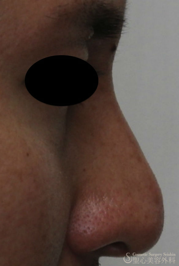 【20代男性・わし鼻の改善】鼻骨削り＋I型シリコンプロテーゼ（1ヶ月） After 