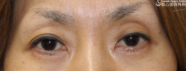 二重 Wノット 埋没法 目頭切開 左目の上ヒアルロン酸 症例写真 美容整形 美容外科なら聖心美容クリニック