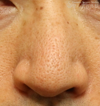 40代男性 鼻の毛穴を目立たなく イントラセル治療 症例写真 美容整形 美容外科なら聖心美容クリニック