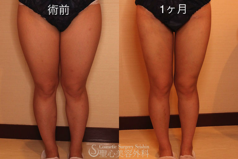【20代 女性　ベイザーリポ2.2】大腿全周＋下腿 After 