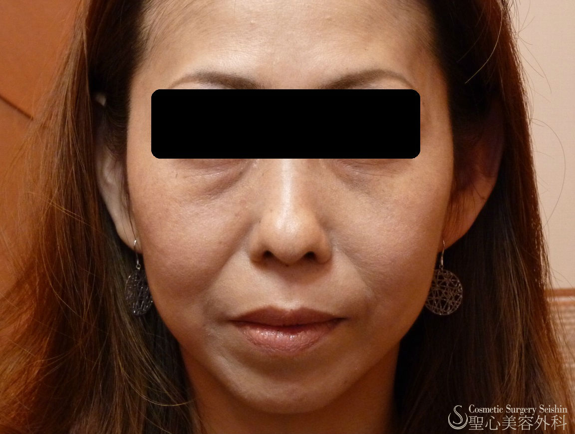 【４０代女性・頬のたるみ】ドクターハイフ（ウルセラシステム）２回目治療（初回との比較あり） Before 