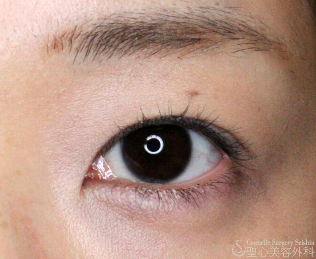 代女性 埋没法で戻る二重 全切開法 脱脂 9ヶ月後 症例写真 美容整形 美容外科なら聖心美容クリニック