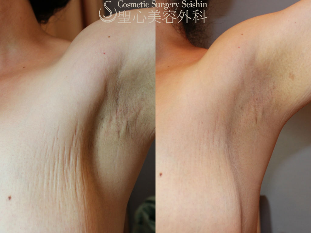 【30代女性・肉割れ治療（ワキ～バスト上部）】イントラセル After 