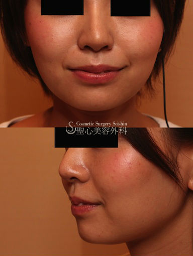 代 女性 すっきり小顔 顎 ヒアルロン酸注入 症例写真 美容整形 美容外科なら聖心美容クリニック