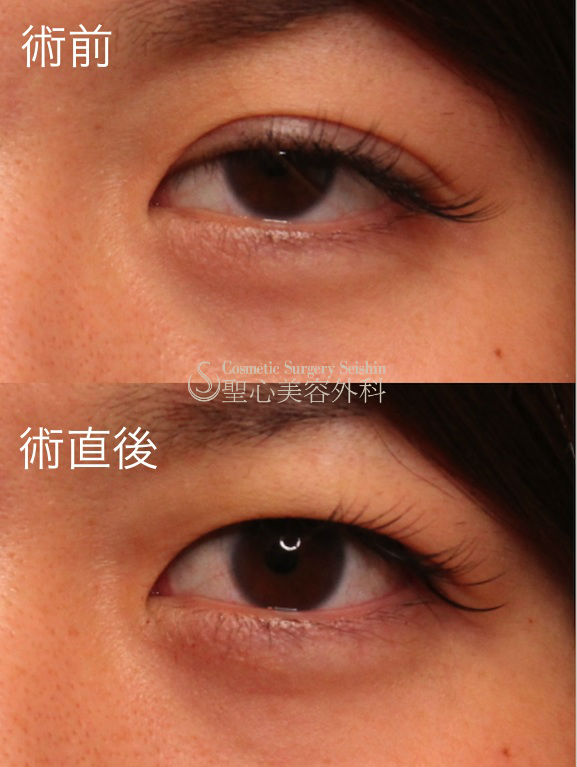 【20代 女性　眼瞼下垂】埋没法 After 