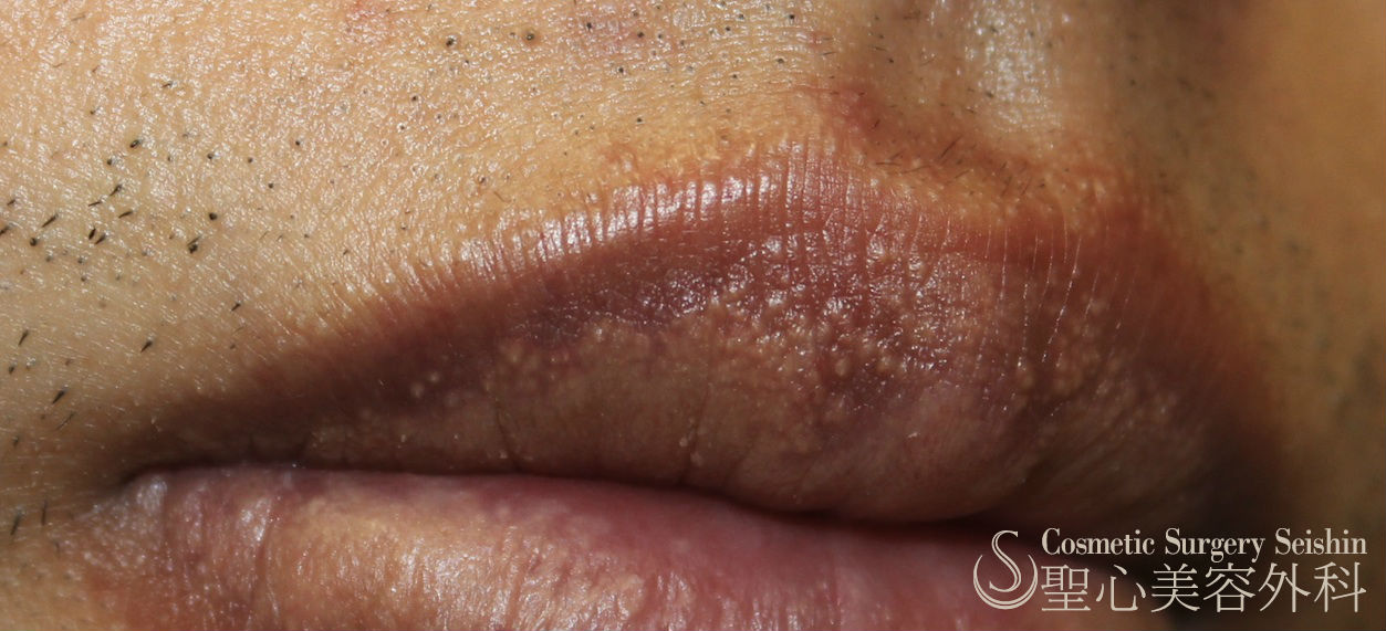 代男性 口唇のブツブツ 口唇フォアダイス状態の治療 ２週間後 症例写真 美容整形 美容外科なら聖心美容クリニック