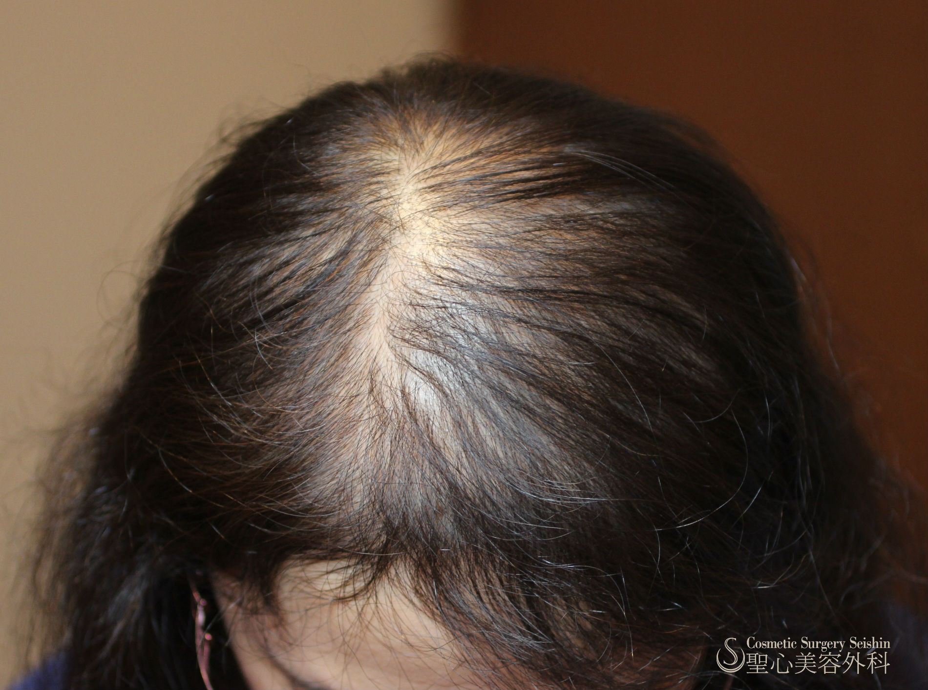 【40代女性：薄毛】グロースファクター再生療法（15回処置後） Before 