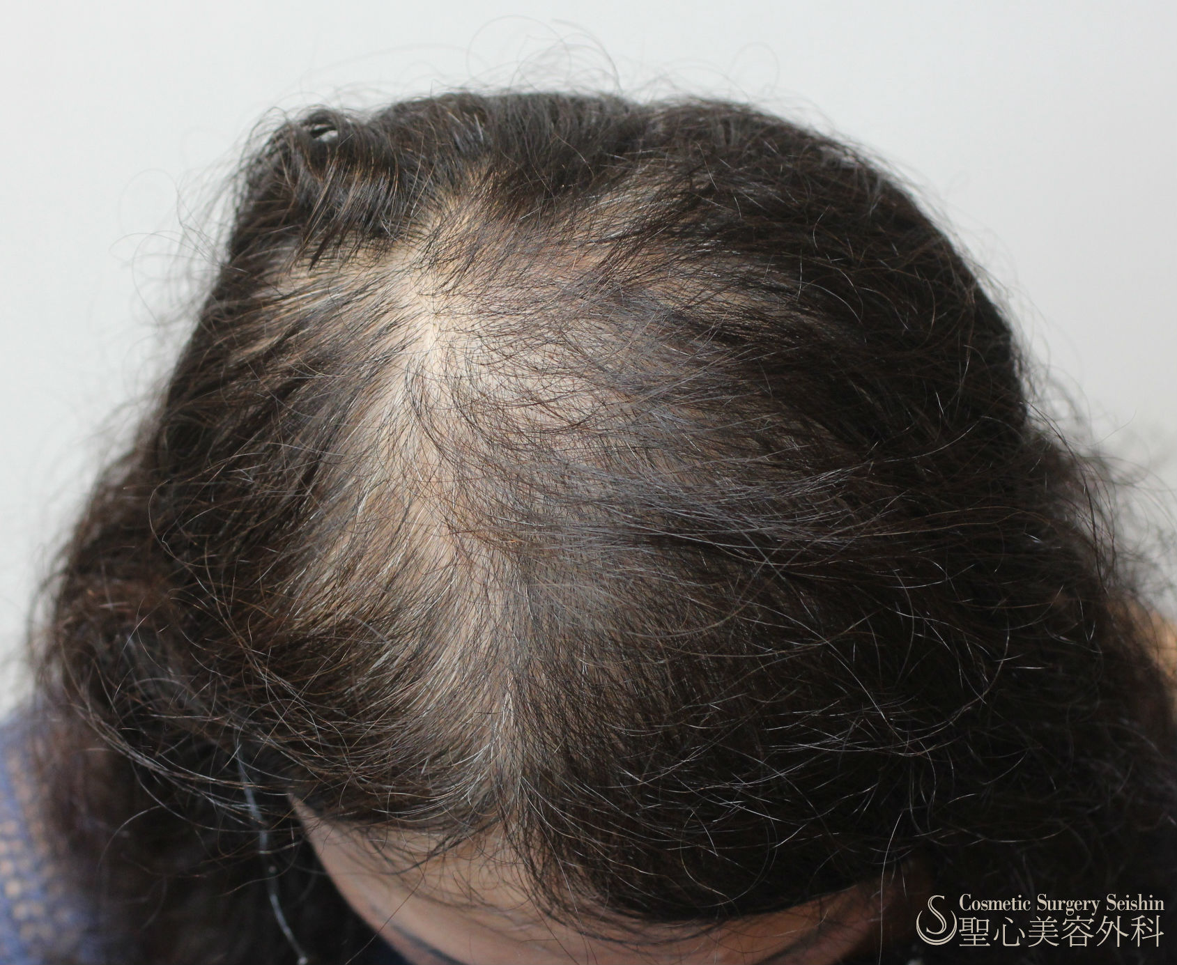 【40代女性：薄毛】グロースファクター再生療法（15回処置後） After 