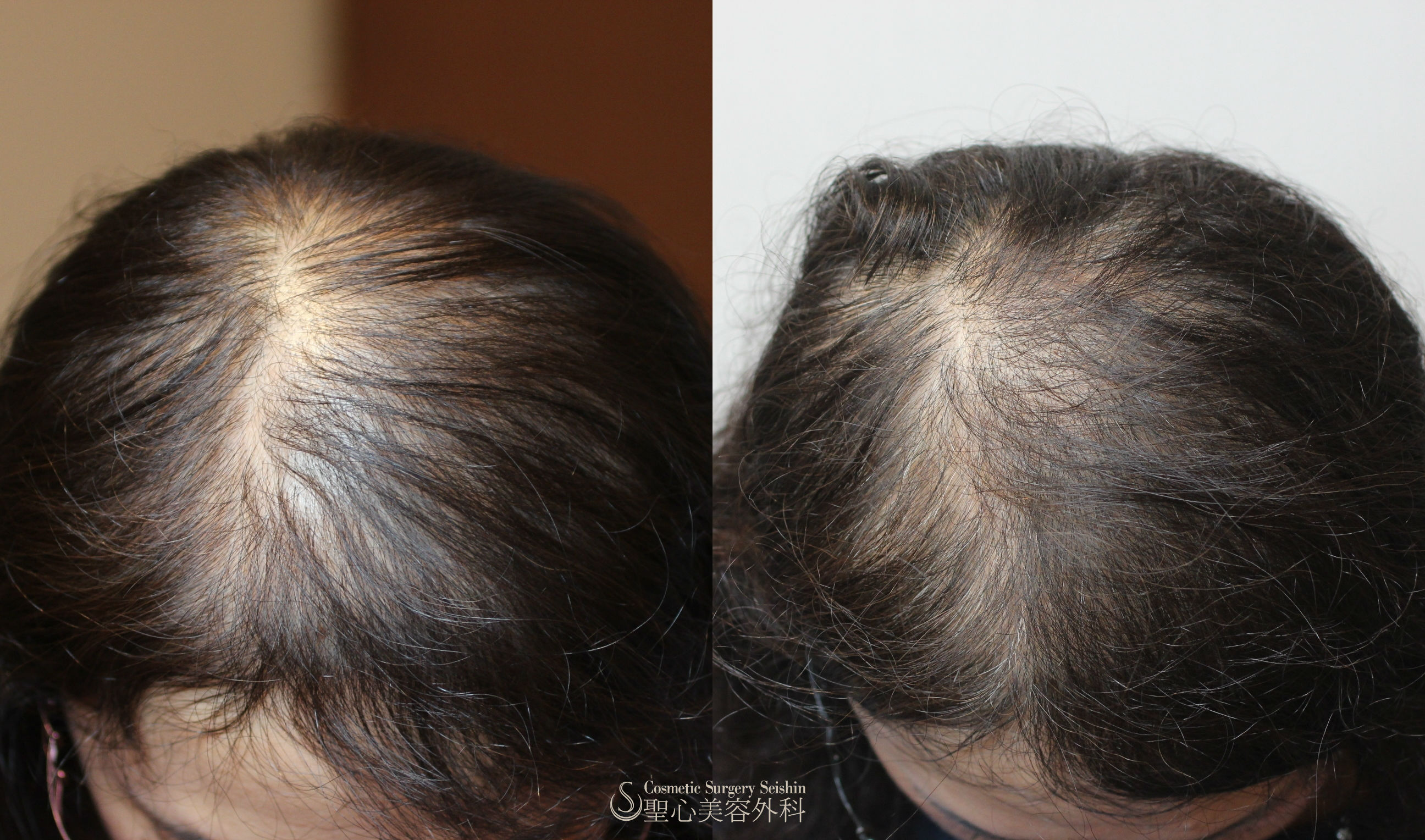 【40代女性：薄毛】グロースファクター再生療法（15回処置後） After 
