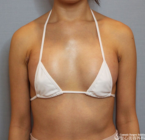 【30代 女性　バストアップ】バッグプロテーゼ After 