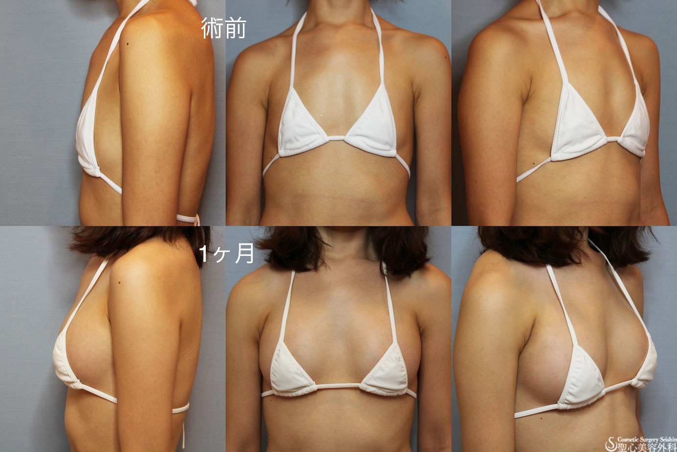 【30代 女性　バストアップ】バッグプロテーゼ After 