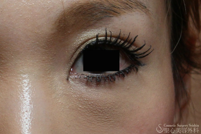 【30代 女性　目の上の凹み】プレミアムPRP皮膚再生療法 After 