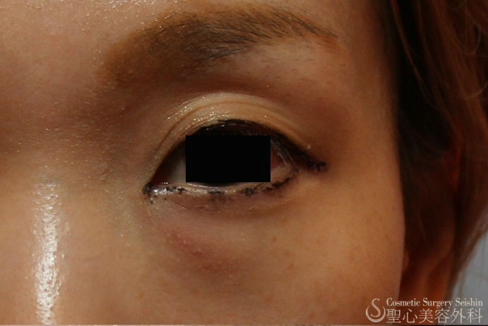 【30代 女性　目の上の凹み】プレミアムPRP皮膚再生療法 Before 