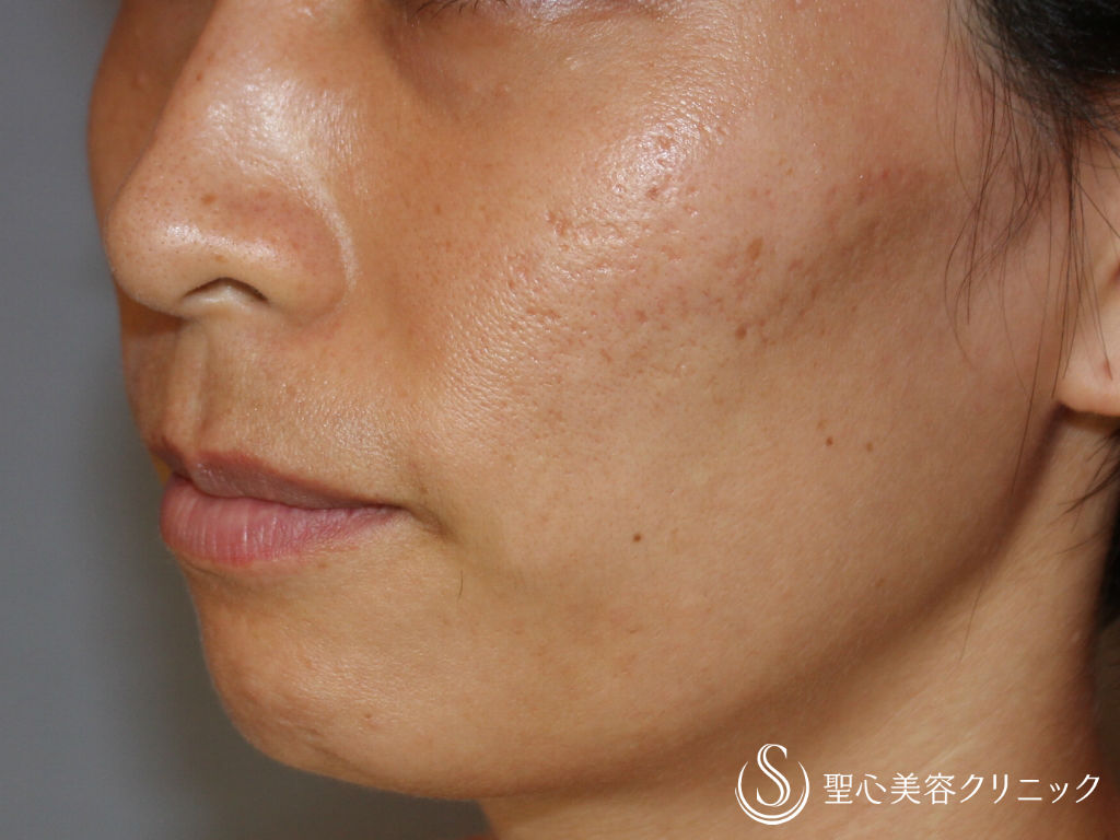 30代女性 ニキビ跡 頬の引き締め イントラセル 症例写真 美容整形 美容外科なら聖心美容クリニック