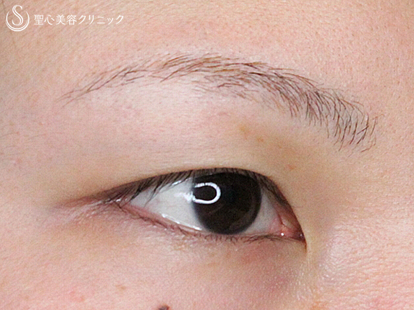 【20代女性・ハーフのような二重】二重全切開＋目頭切開（1年3ヶ月後） 症例写真 美容整形、美容外科なら聖心美容クリニック