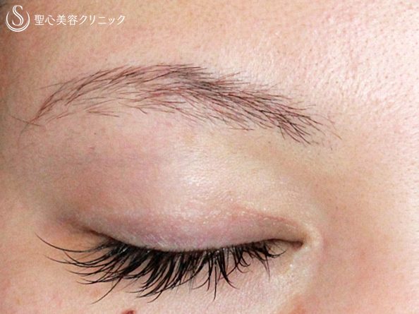 【20代女性・ハーフのような二重】二重全切開＋目頭切開（1年3ヶ月後） After 