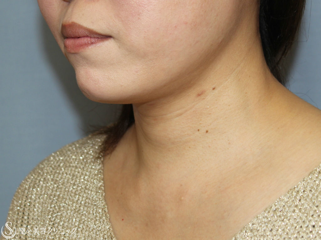 【30代女性・あご下～首のたるみ取り】ネックリフト（術後1ヶ月） After 