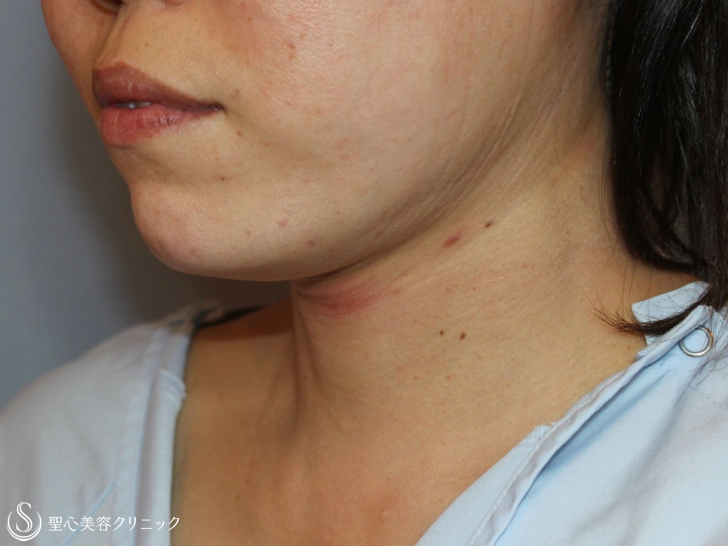 【30代女性・あご下～首のたるみ取り】ネックリフト（術後1ヶ月） After 