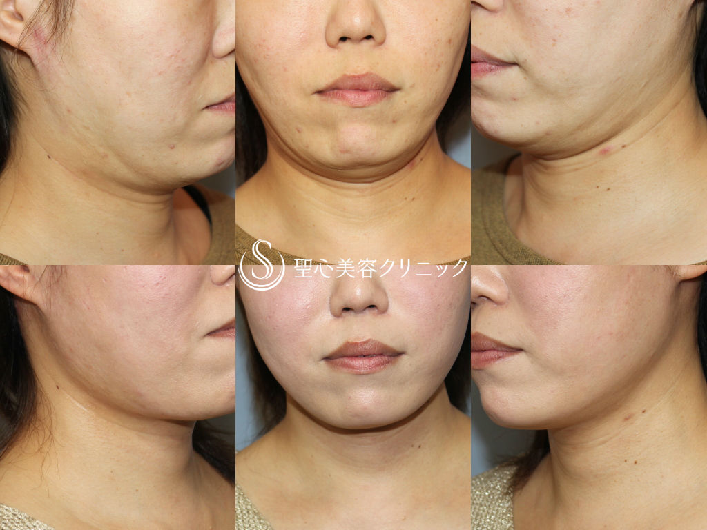 【30代女性・あご下～首のたるみ取り】ネックリフト（術後1ヶ月） After 